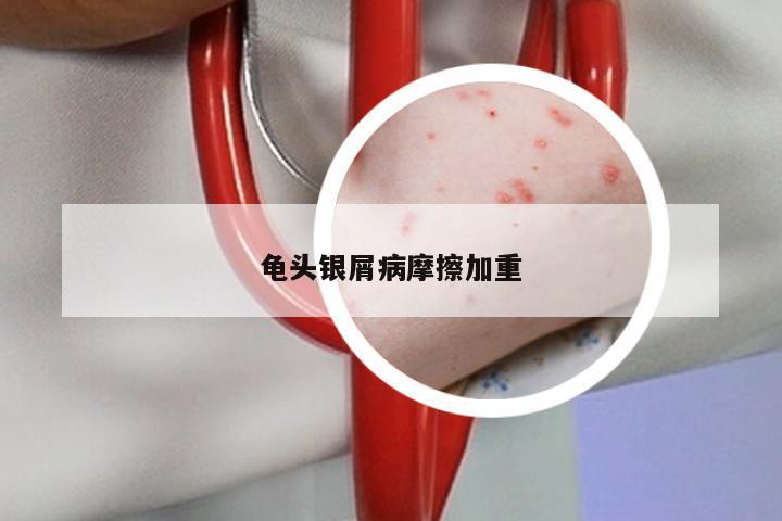 龟头银屑病摩擦加重