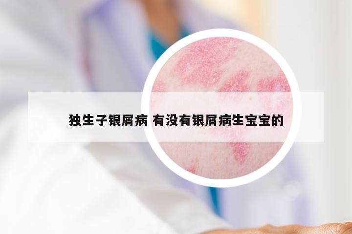独生子银屑病 有没有银屑病生宝宝的