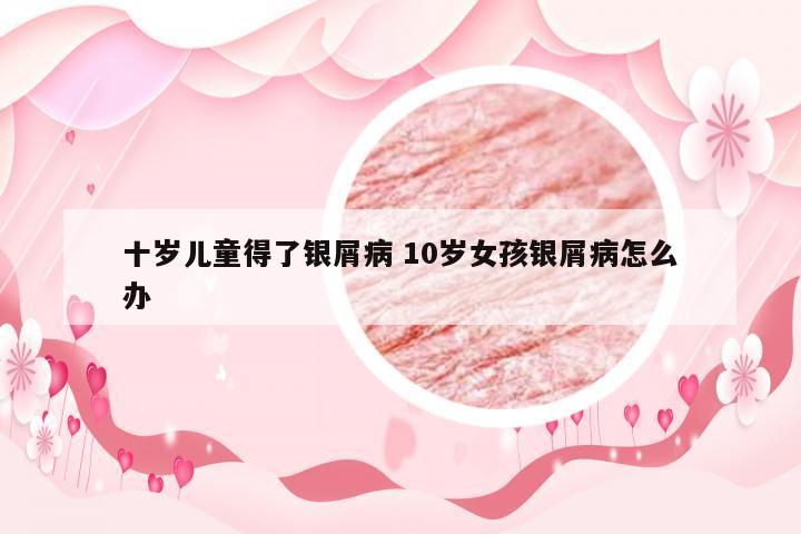 十岁儿童得了银屑病 10岁女孩银屑病怎么办