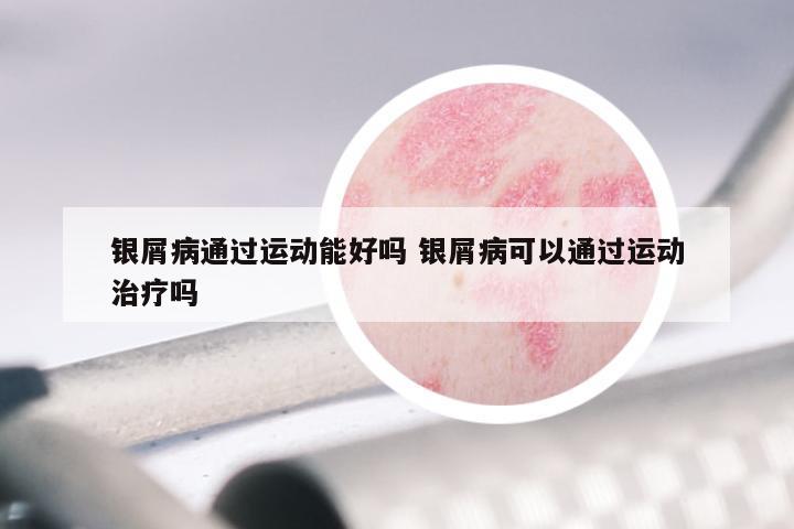 银屑病通过运动能好吗 银屑病可以通过运动治疗吗