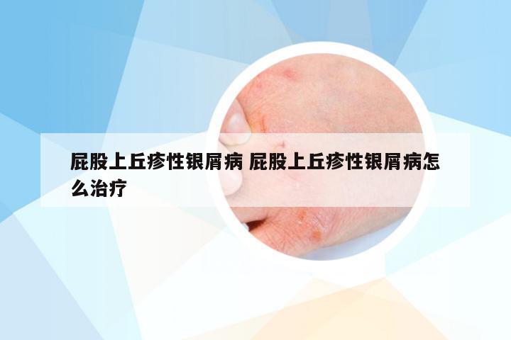 屁股上丘疹性银屑病 屁股上丘疹性银屑病怎么治疗