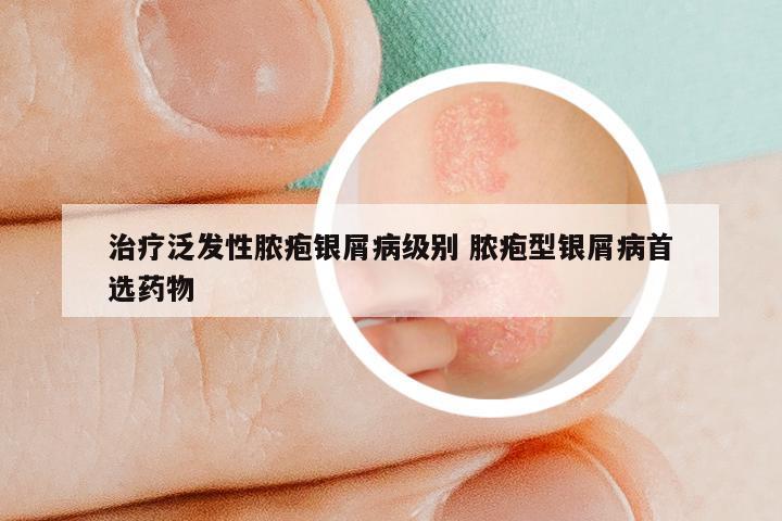 治疗泛发性脓疱银屑病级别 脓疱型银屑病首选药物