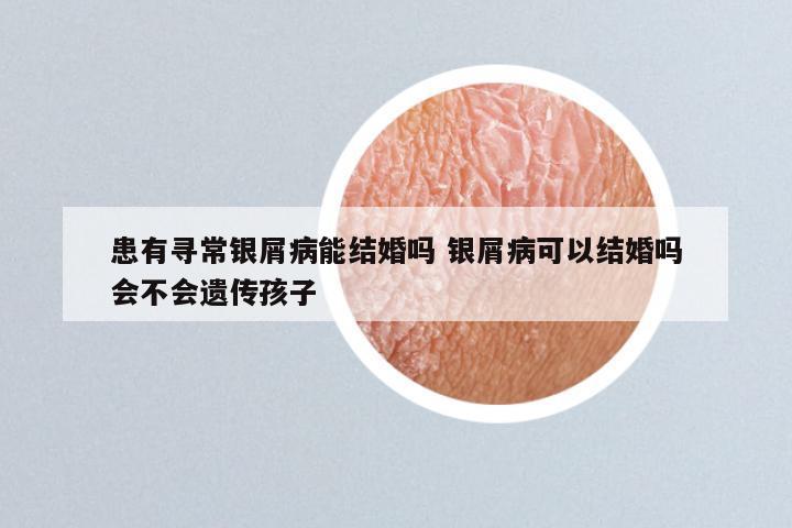 患有寻常银屑病能结婚吗 银屑病可以结婚吗会不会遗传孩子