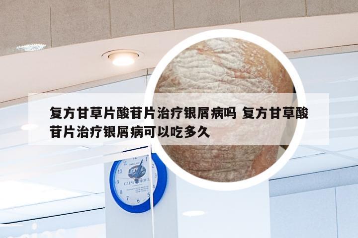 复方甘草片酸苷片治疗银屑病吗 复方甘草酸苷片治疗银屑病可以吃多久