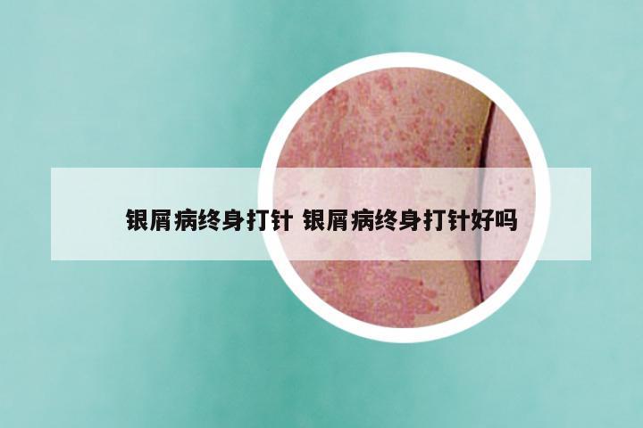 银屑病终身打针 银屑病终身打针好吗