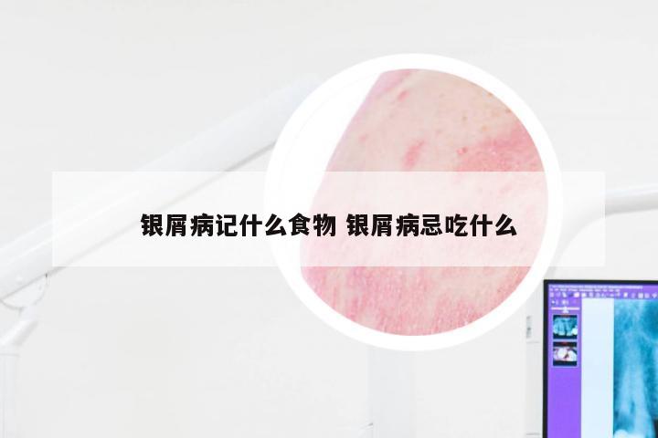 银屑病记什么食物 银屑病忌吃什么