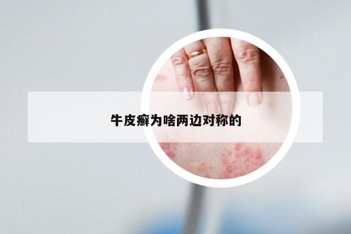 牛皮癣为啥两边对称的