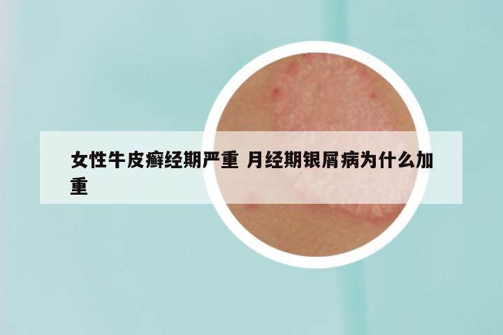 女性牛皮癣经期严重 月经期银屑病为什么加重