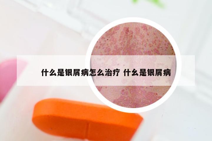 什么是银屑病怎么治疗 什幺是银屑病
