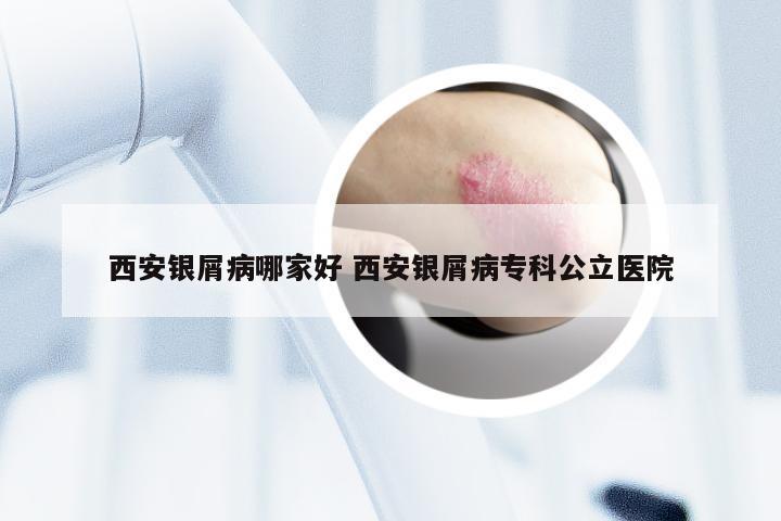 西安银屑病哪家好 西安银屑病专科公立医院