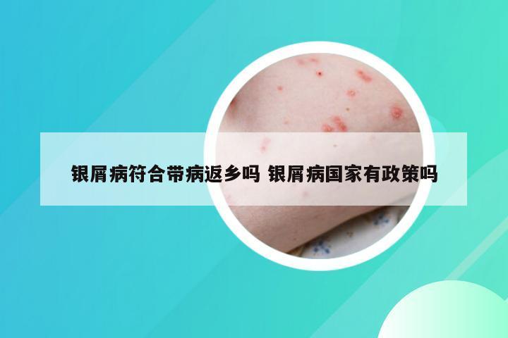 银屑病符合带病返乡吗 银屑病国家有政策吗