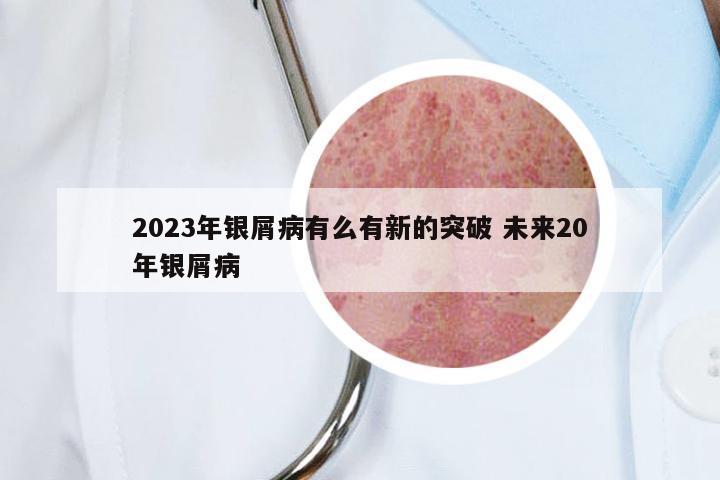 2023年银屑病有么有新的突破 未来20年银屑病