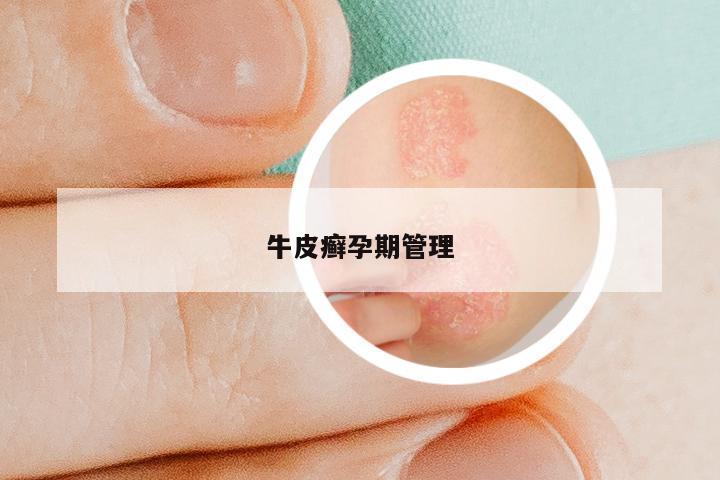 牛皮癣孕期管理