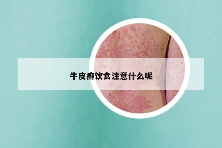 牛皮癣饮食注意什么呢