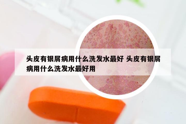 头皮有银屑病用什么洗发水最好 头皮有银屑病用什么洗发水最好用