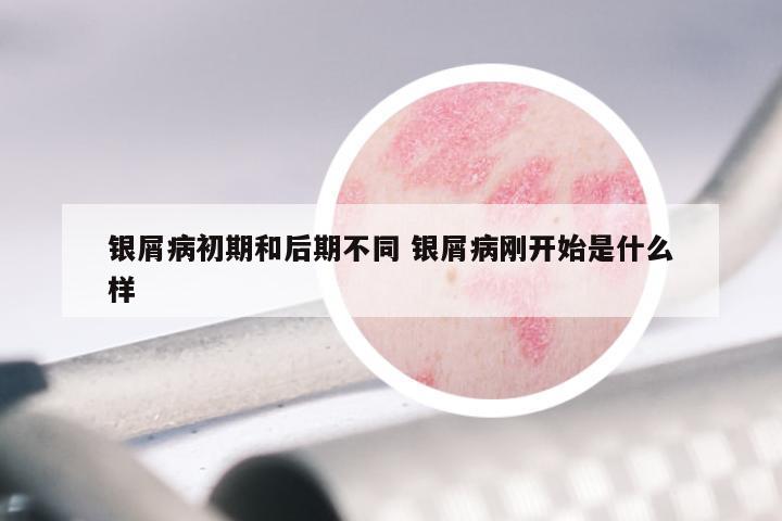 银屑病初期和后期不同 银屑病刚开始是什么样