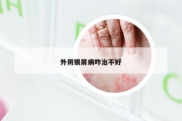 外阴银屑病咋治不好