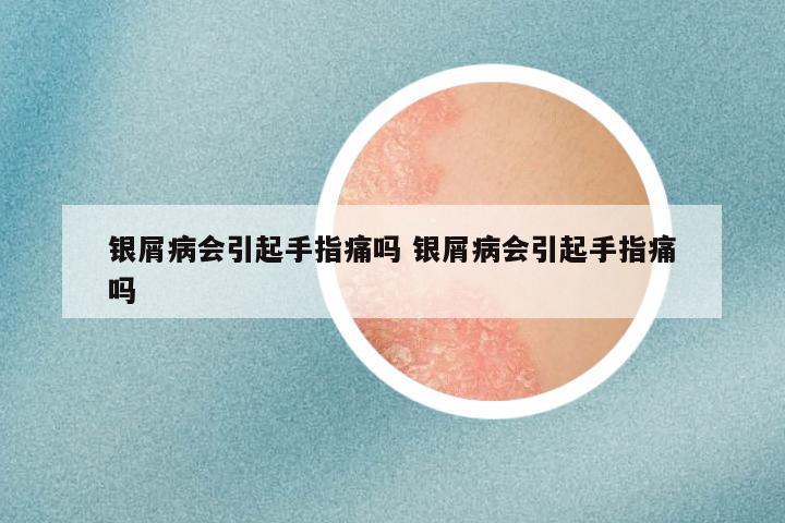 银屑病会引起手指痛吗 银屑病会引起手指痛吗