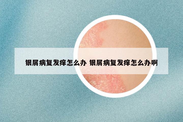银屑病复发痒怎么办 银屑病复发痒怎么办啊