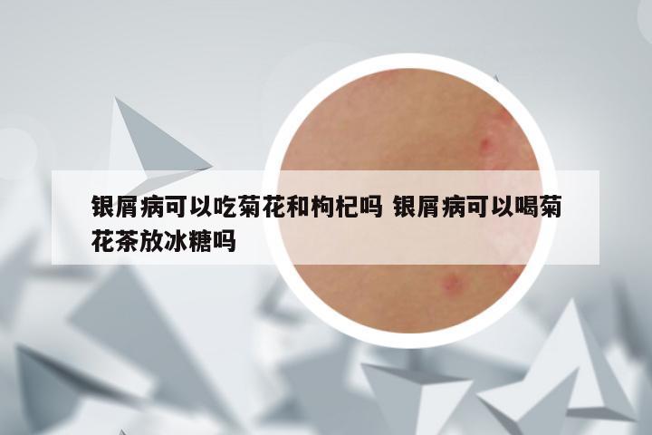 银屑病可以吃菊花和枸杞吗 银屑病可以喝菊花茶放冰糖吗
