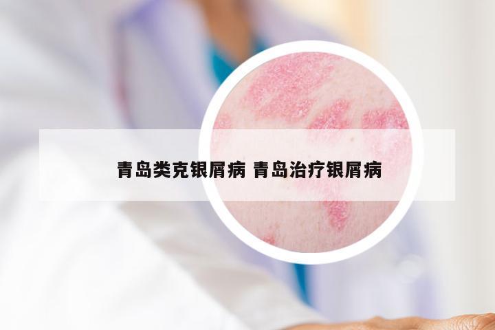 青岛类克银屑病 青岛治疗银屑病