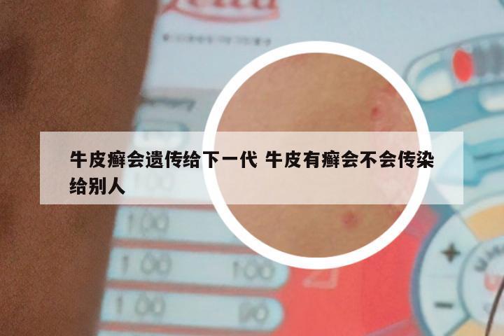 牛皮癣会遗传给下一代 牛皮有癣会不会传染给别人
