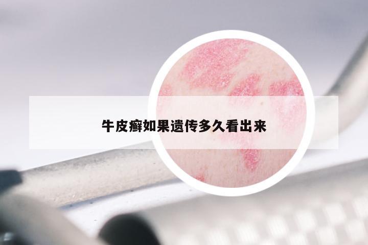 牛皮癣如果遗传多久看出来