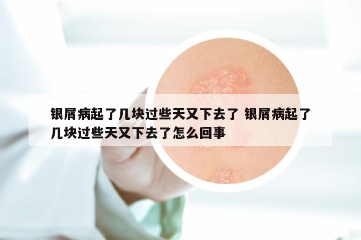 银屑病起了几块过些天又下去了 银屑病起了几块过些天又下去了怎么回事