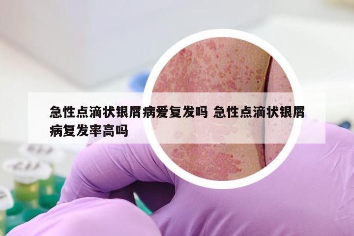 急性点滴状银屑病爱复发吗 急性点滴状银屑病复发率高吗