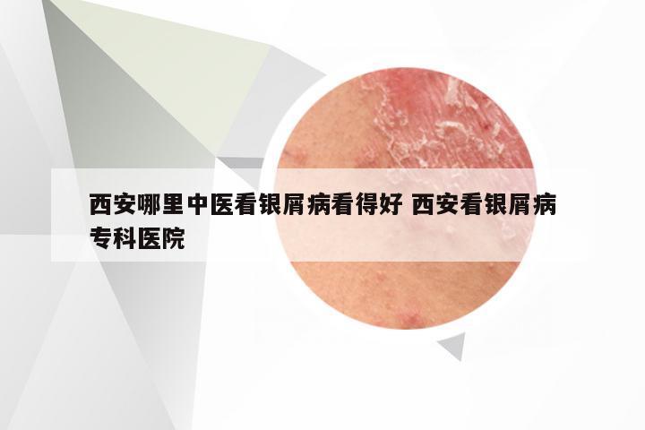 西安哪里中医看银屑病看得好 西安看银屑病专科医院