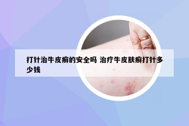 打针治牛皮癣的安全吗 治疗牛皮肤癣打针多少钱