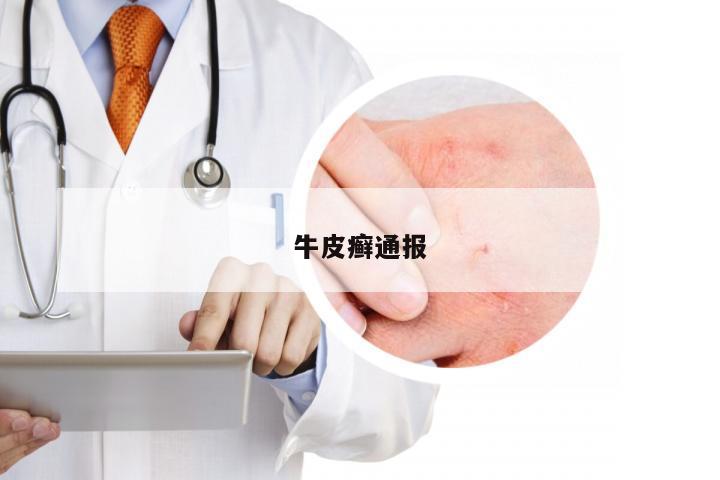 牛皮癣通报