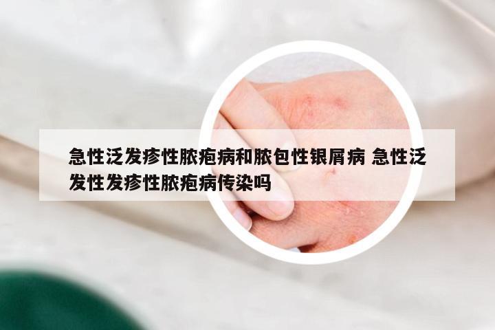 急性泛发疹性脓疱病和脓包性银屑病 急性泛发性发疹性脓疱病传染吗