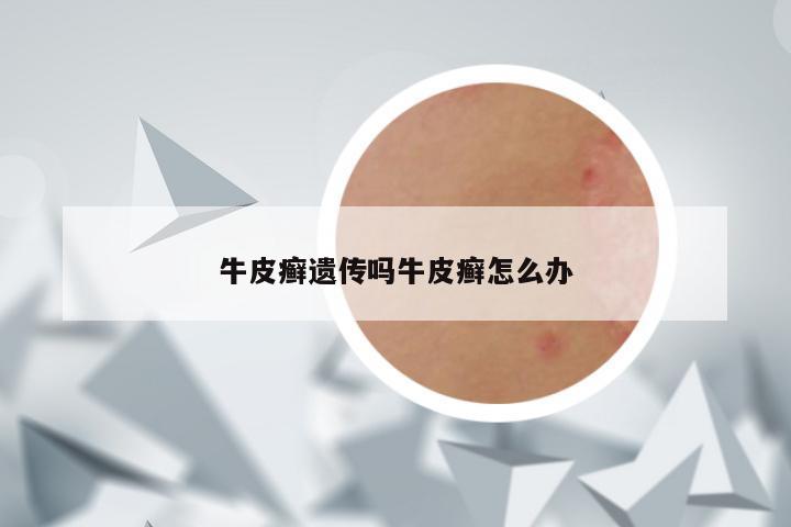 牛皮癣遗传吗牛皮癣怎么办