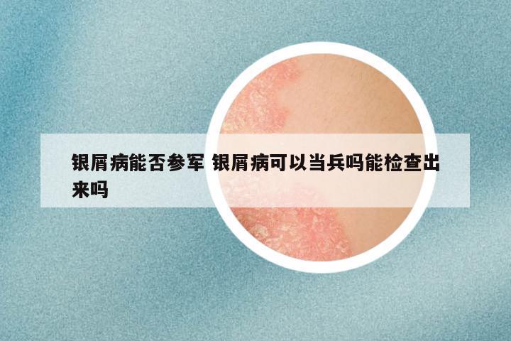 银屑病能否参军 银屑病可以当兵吗能检查出来吗