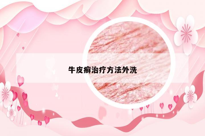 牛皮癣治疗方法外洗