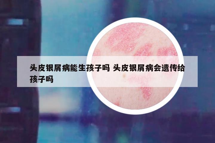 头皮银屑病能生孩子吗 头皮银屑病会遗传给孩子吗