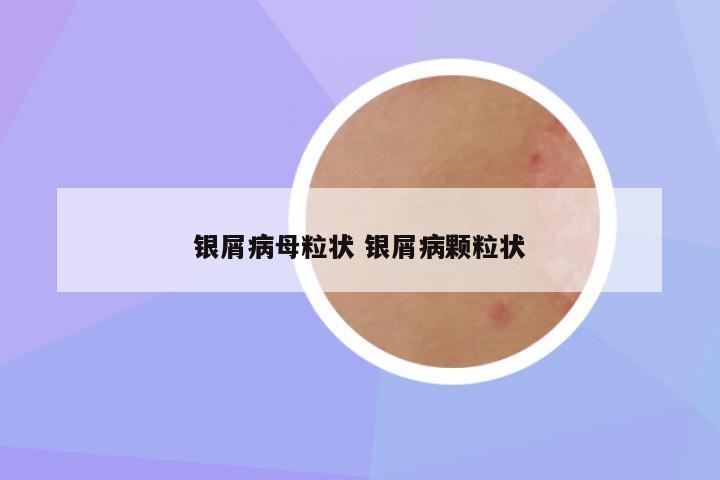 银屑病母粒状 银屑病颗粒状