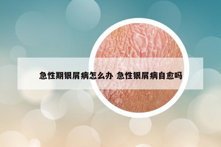 急性期银屑病怎么办 急性银屑病自愈吗