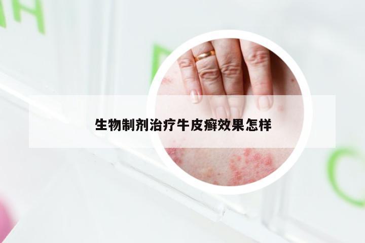生物制剂治疗牛皮癣效果怎样