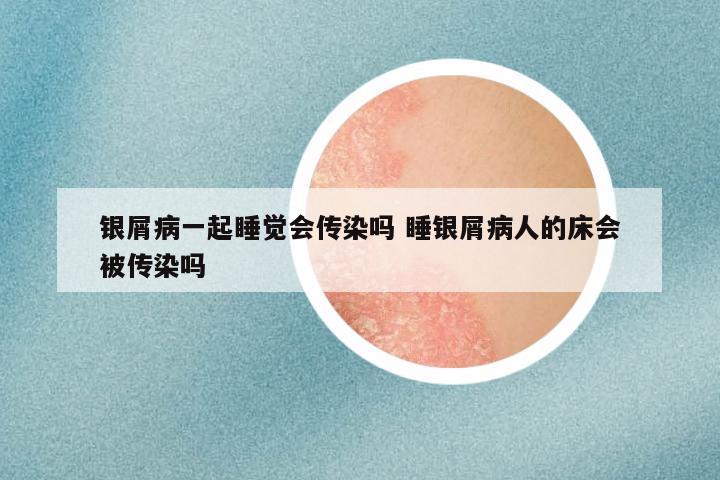 银屑病一起睡觉会传染吗 睡银屑病人的床会被传染吗