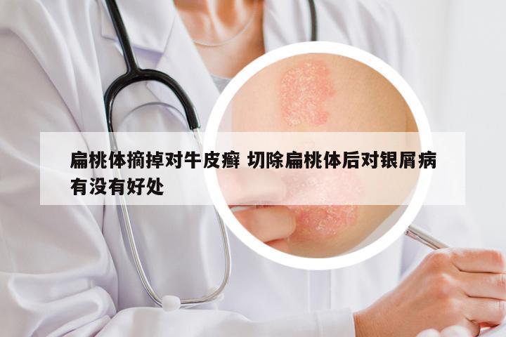 扁桃体摘掉对牛皮癣 切除扁桃体后对银屑病有没有好处