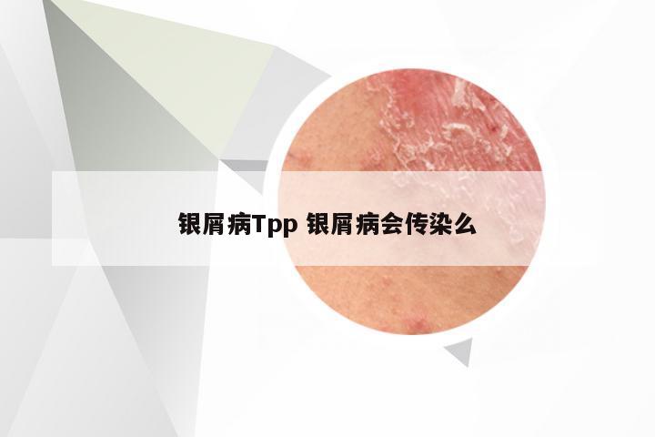 银屑病Tpp 银屑病会传染么