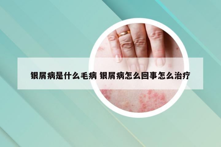 银屑病是什么毛病 银屑病怎么回事怎么治疗
