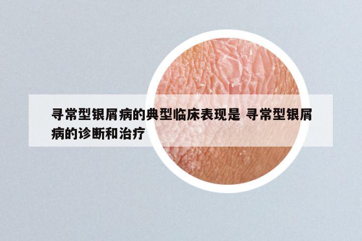 寻常型银屑病的典型临床表现是 寻常型银屑病的诊断和治疗