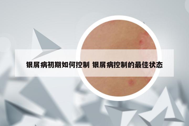 银屑病初期如何控制 银屑病控制的最佳状态