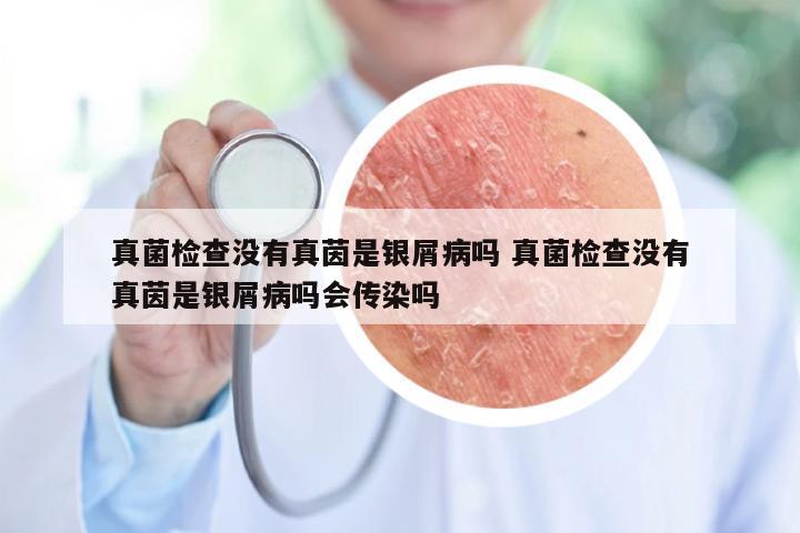 真菌检查没有真茵是银屑病吗 真菌检查没有真茵是银屑病吗会传染吗