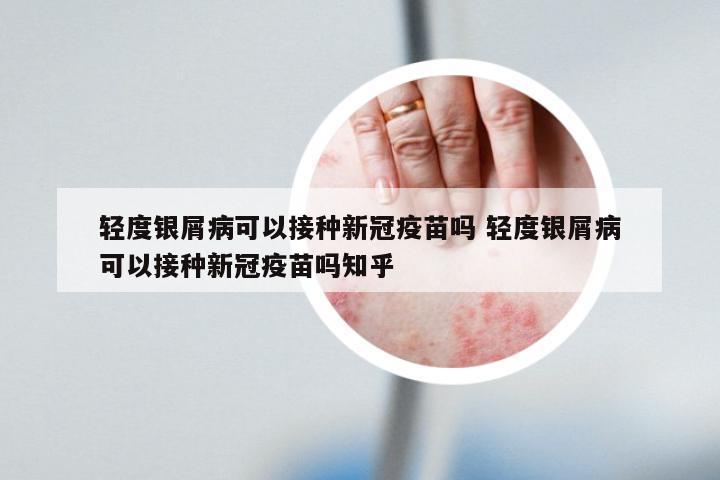 轻度银屑病可以接种新冠疫苗吗 轻度银屑病可以接种新冠疫苗吗知乎