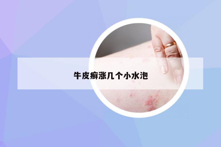牛皮癣涨几个小水泡