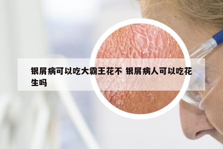 银屑病可以吃大霸王花不 银屑病人可以吃花生吗